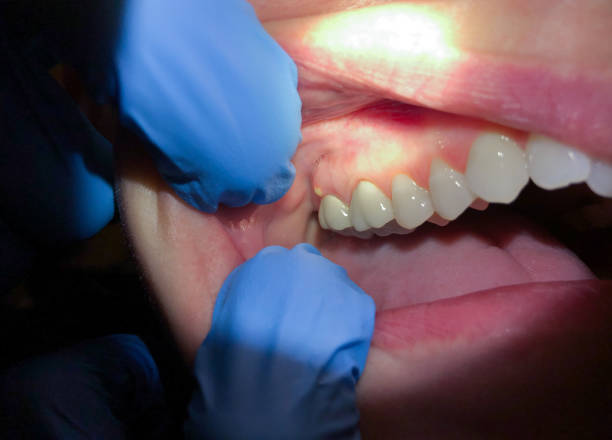 Best Emergency Dentist for Lost Fillings or Crowns in Glen Alpine, NC